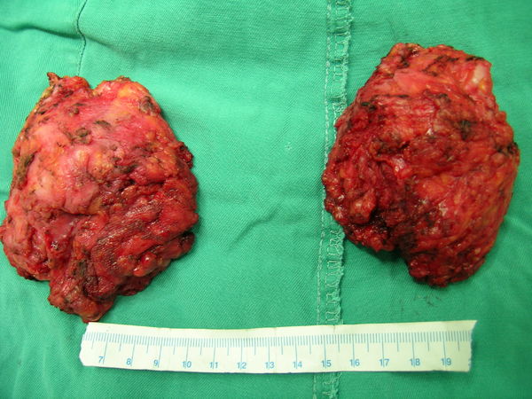 肩胛骨弹力纤维瘤图片图片