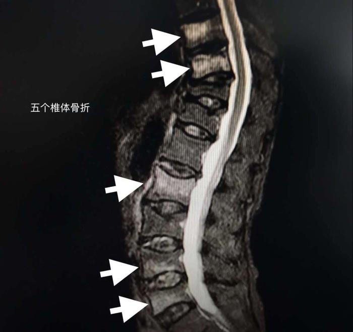 打个喷嚏就骨折了和老年患者谈谈椎体压缩性骨折