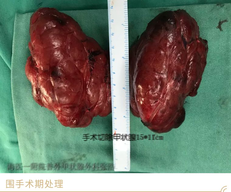 难治性弥漫性毒性巨大甲状腺伴重度甲亢患者顺利出院啦