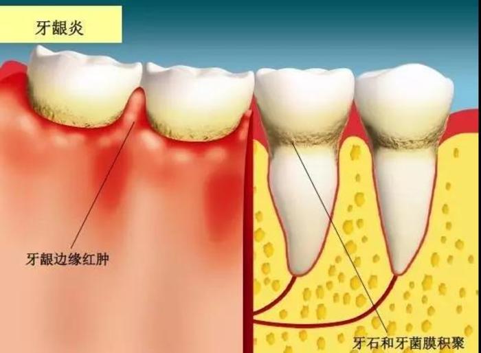 牙龈出血牙缝变大口臭原因大揭秘