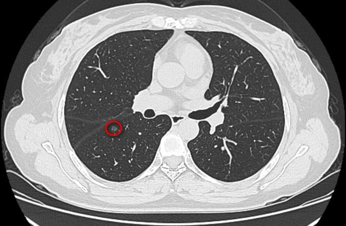 單孔胸腔鏡治療多發肺磨玻璃結節