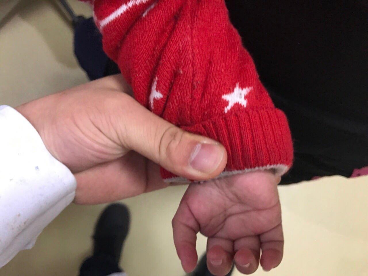 食指拇化术治疗漂浮指畸形