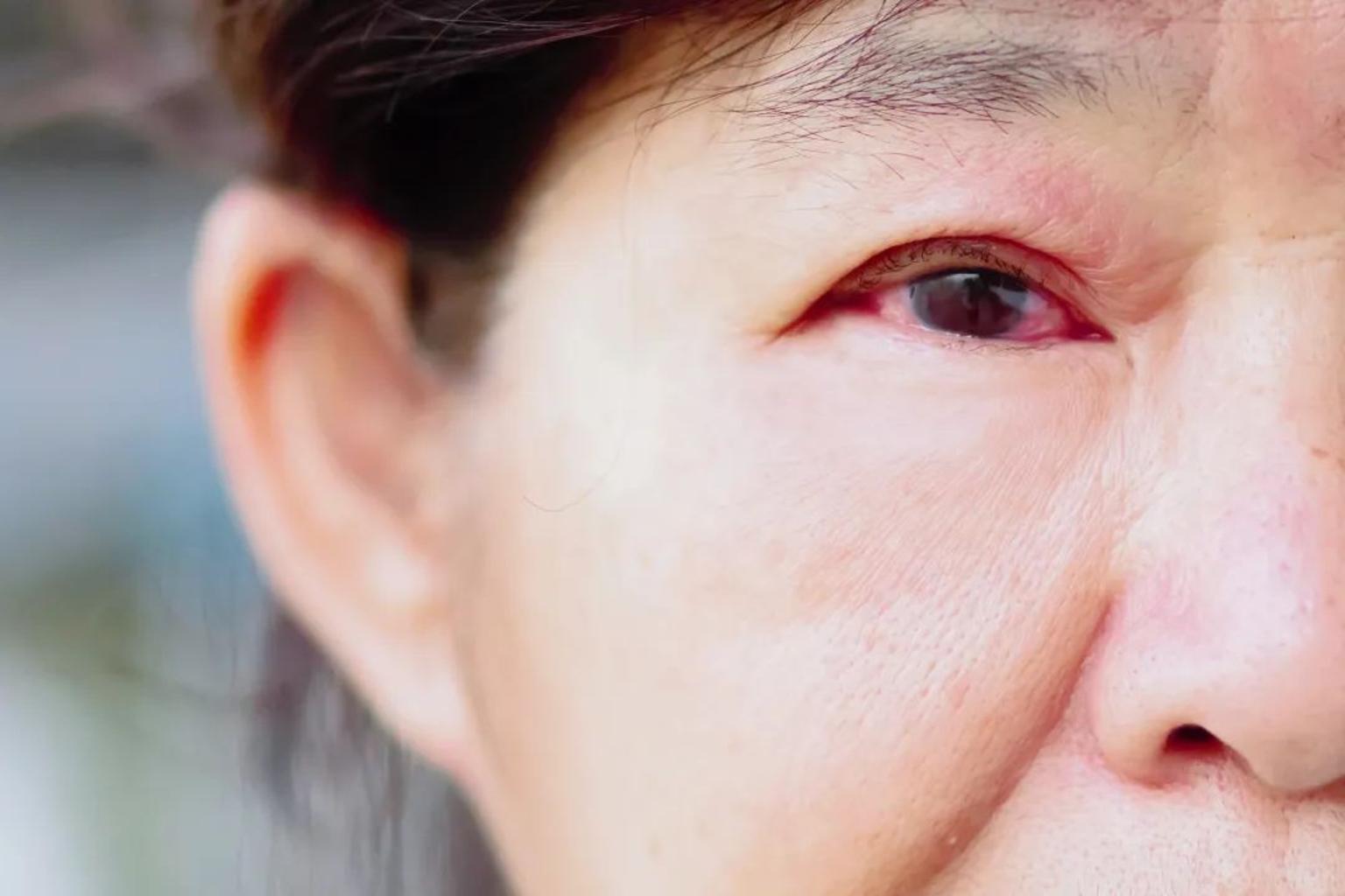 眼睛经常干涩发痒,是得了「干眼症」吗?_健康号-微医