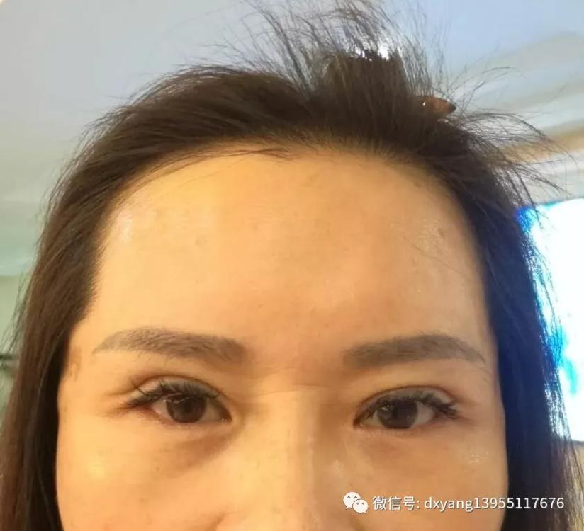 如何重建美丽自然的眉睑形态之二 健康号 微医