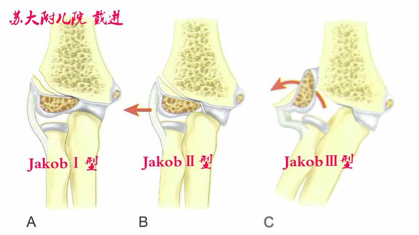 肘关节造影术在儿童肱骨外髁骨折中的应用 健康号 微医