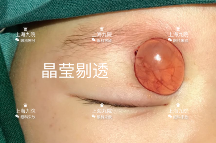 眼肿瘤系列科普眼眶囊肿