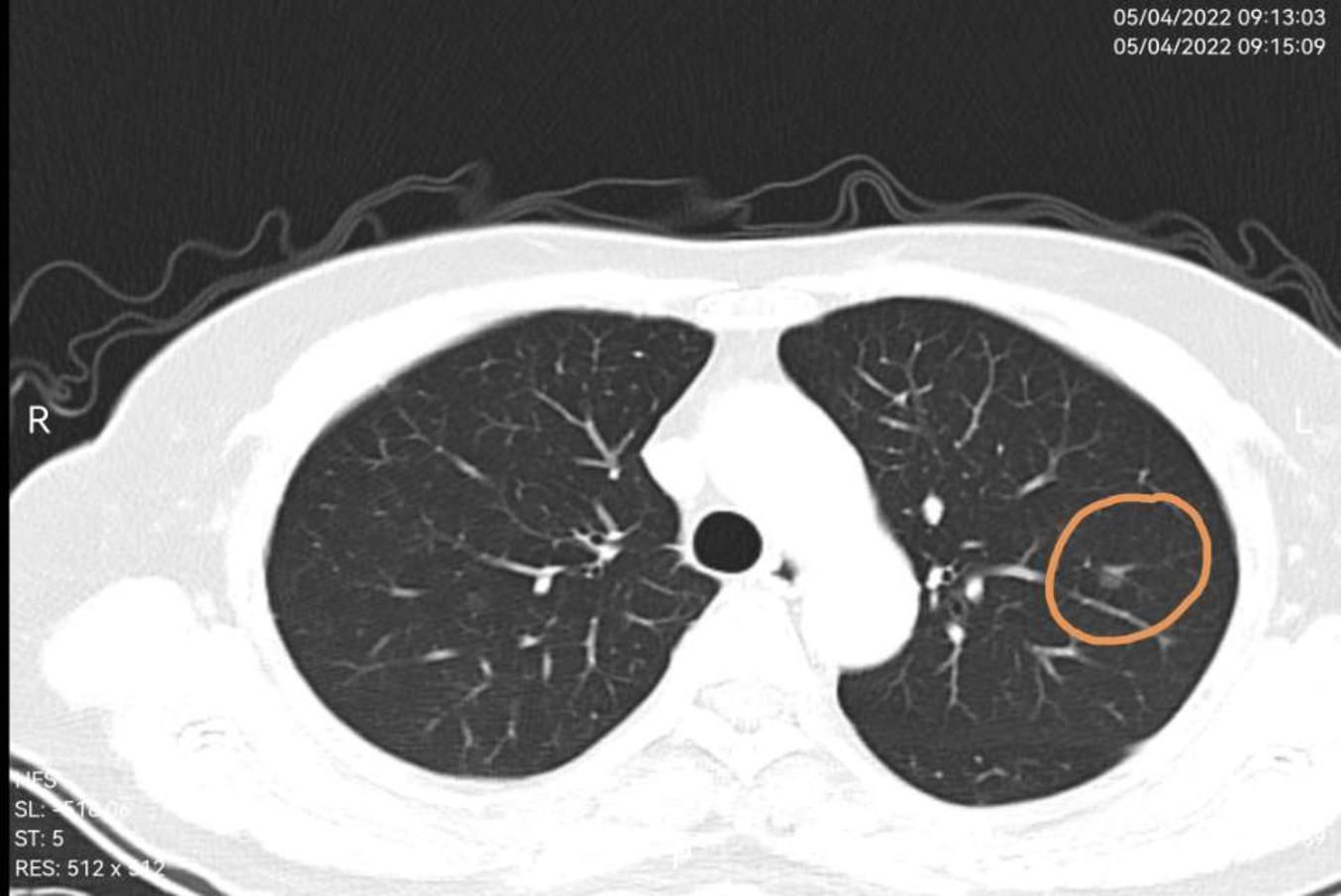 Cell重磅 | 中国学者多单位合作，首次系统揭示肺腺癌分子全景图谱 | 药时代