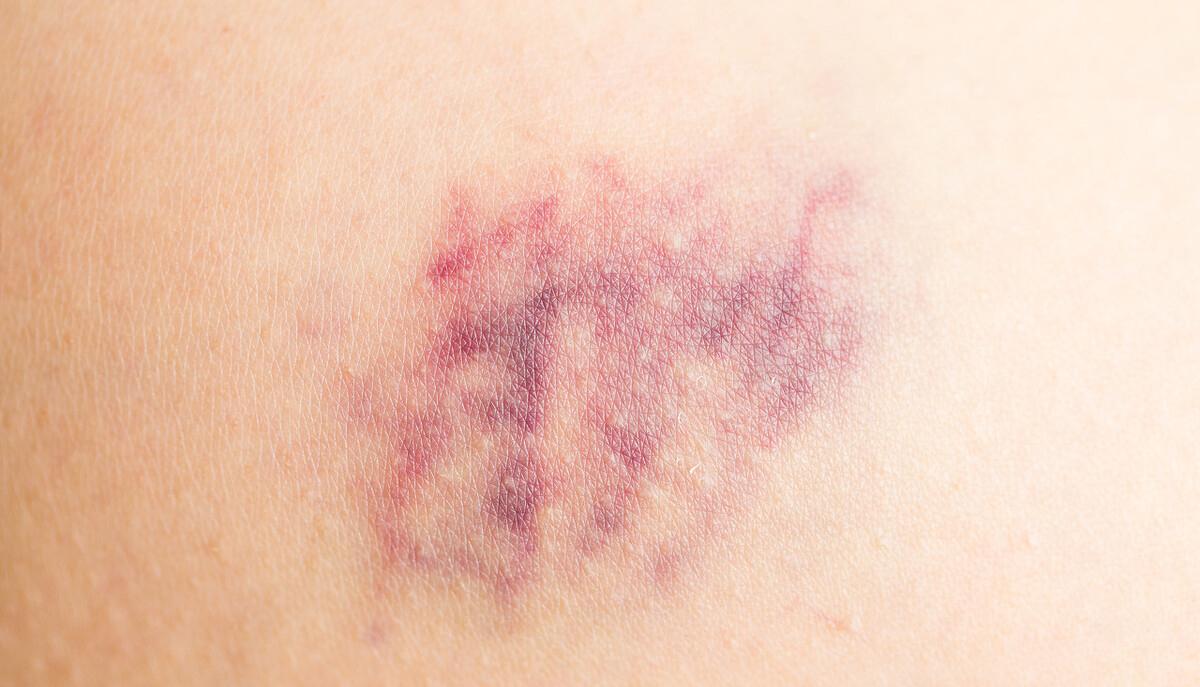 血小板不明原因低下,而且跟临床症状体征不符,会是什么原因呢?