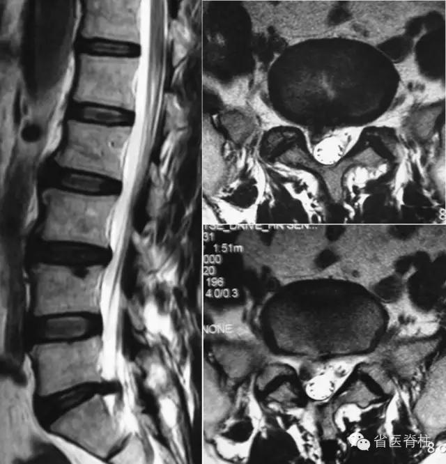 側路腰椎間孔鏡手術治療l5-s1椎間盤突出症復發