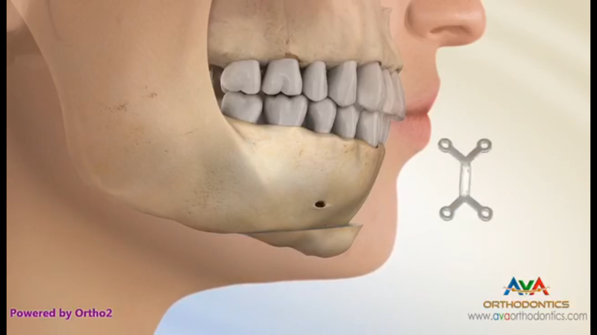 颏成型手术:适用于中重度后缩_刘翔宇医生文章_西安交通大学第一附属
