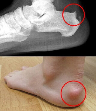 1, 难看,骨质增生到一定程度,脚后跟一大块凸起,鞋子穿不进,穿进去