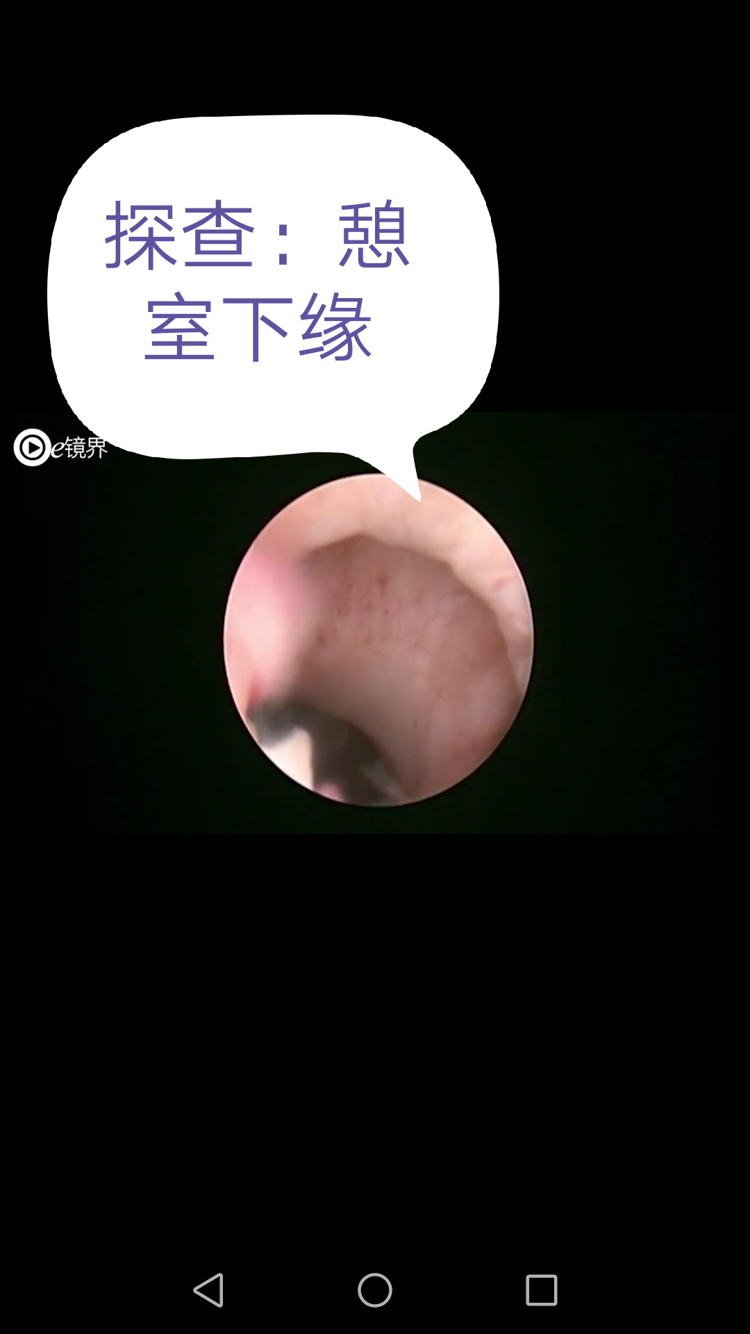 手术解析宫腔镜下切除剖宫产术后子宫切口憩室