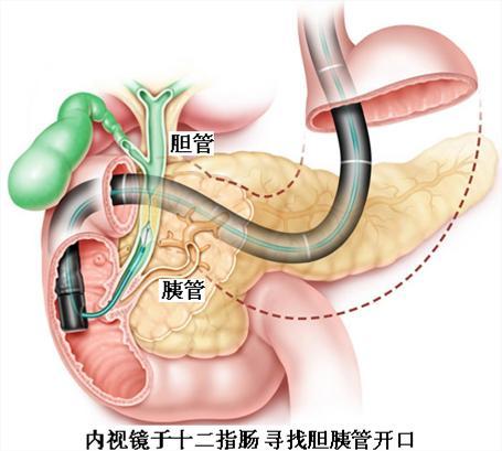 尽量减少不必要的胰管显影,以防术后胰腺炎的发生.