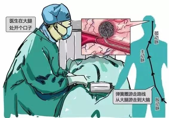 给钱阿姨采用的介入栓塞术是一种微创手术,无需开颅,也是现在临床应用