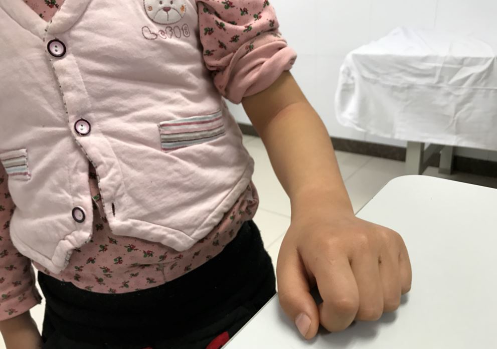 从徐州靓点舞校小美女肘关节不能活动谈小儿桡骨头半脱位_高绪仁医生