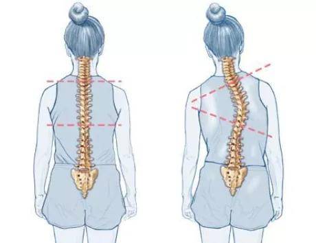 脊柱側彎有多嚇人一文告訴你真相