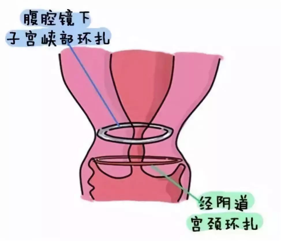 中晚期流产当心宫颈机能不全