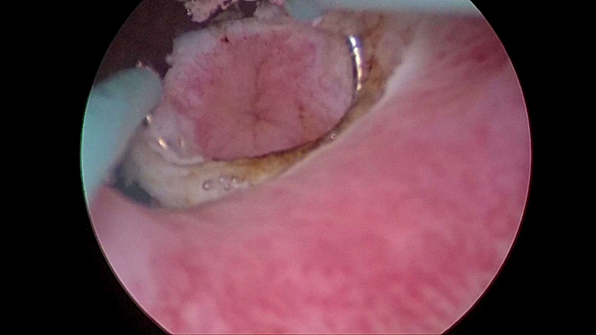 输尿管开口囊肿的微创治疗