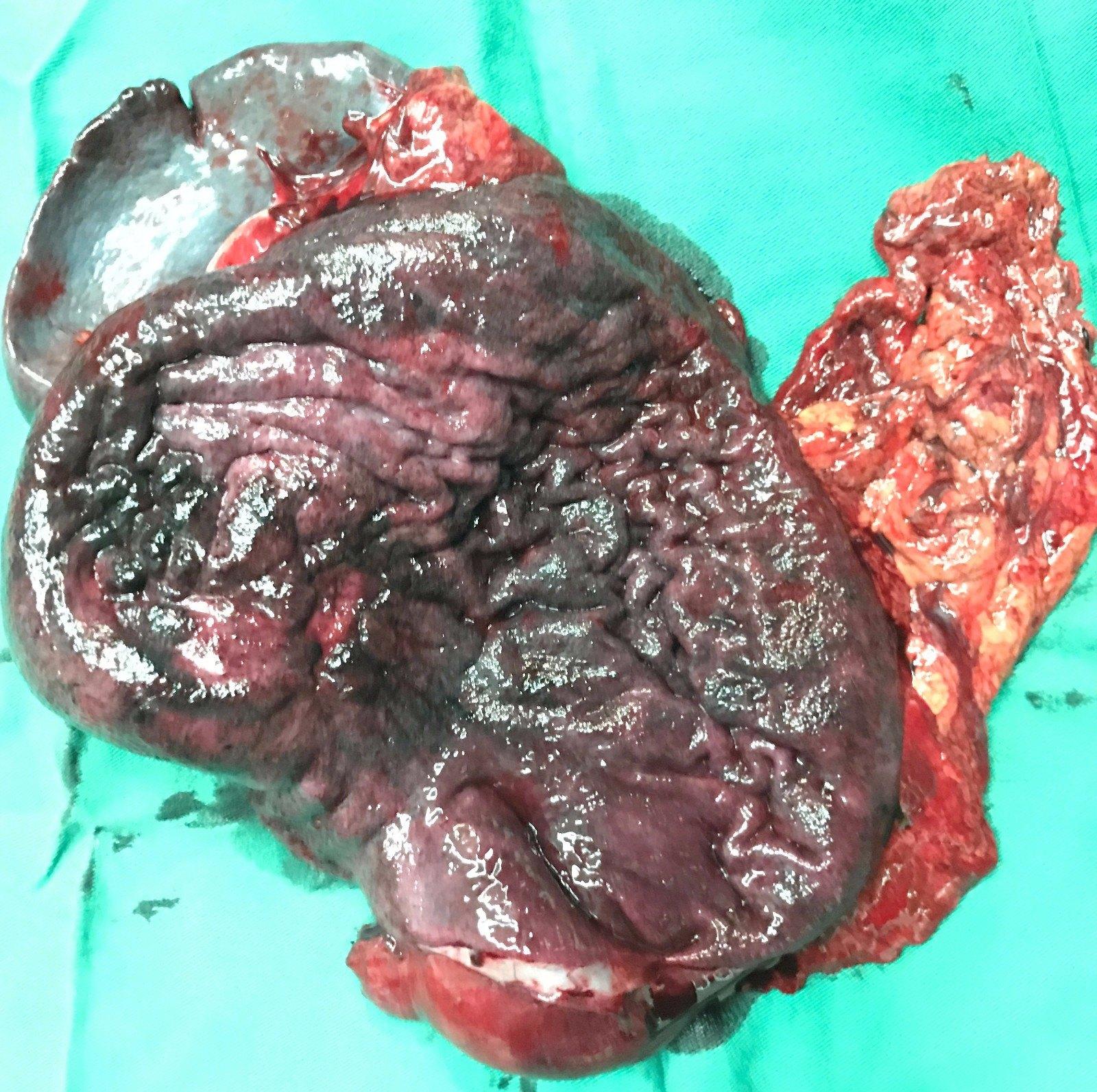 上帝也许为你留了一扇窗这是今日胃癌患者切下的标本照