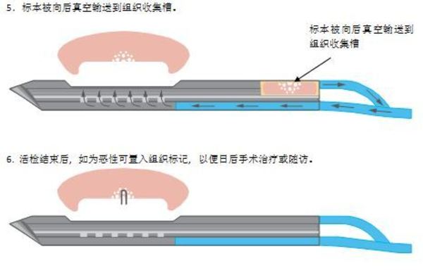 麦默通乳腺包块微创手术的适应症及禁忌症