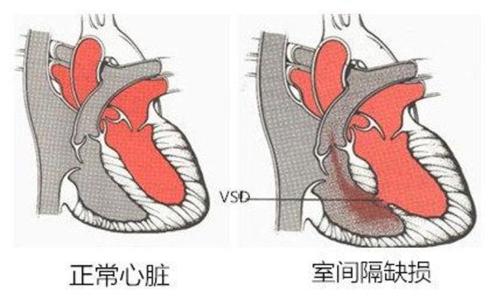 室间隔缺损最常见的先天性心脏病