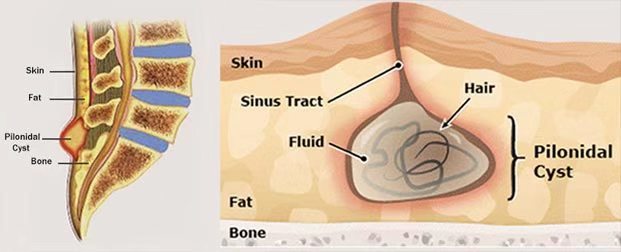 3分钟读懂系列之骶尾部藏毛窦