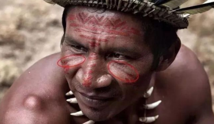 针对印第安纹的剥离手术切口在哪里填充剂选什么