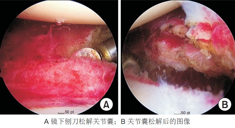 le lievre and murrell采用关节镜松解治疗49位肩周