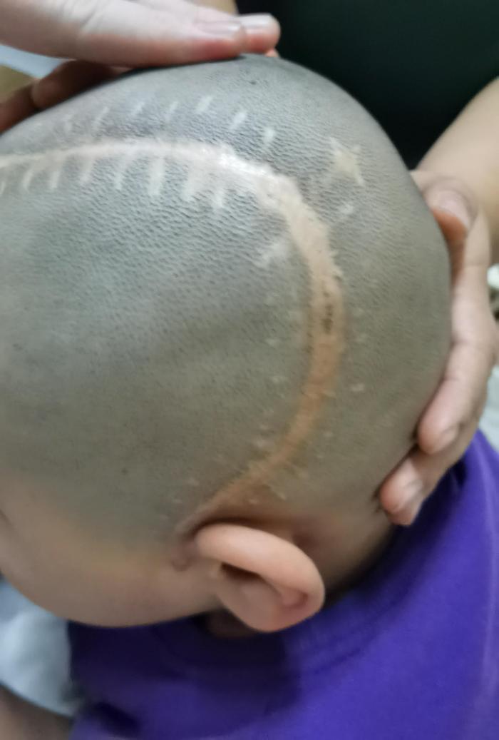 颅骨修补术中头皮切口缝合技术