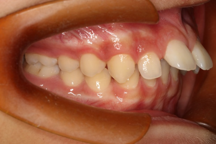 一般来说深覆合分成两种,一种是上前牙唇倾伴前牙深覆盖的深覆合.