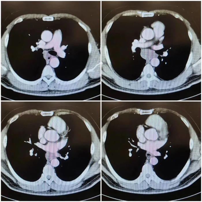 从ct图像上看,肿瘤位于食管右侧,从奇静脉弓水平至下叶静脉水平,从右
