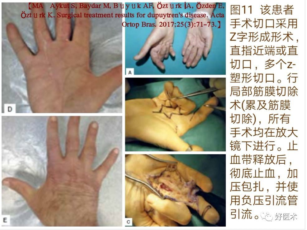 掌腱膜挛缩症的诊治技巧系统详解