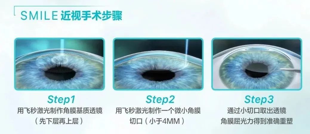 全飞秒手术指使用飞秒激光的切割技术,在角膜基质层通过两层切削分割