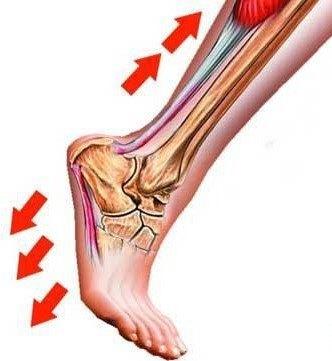 跟腱炎小病带来大麻烦