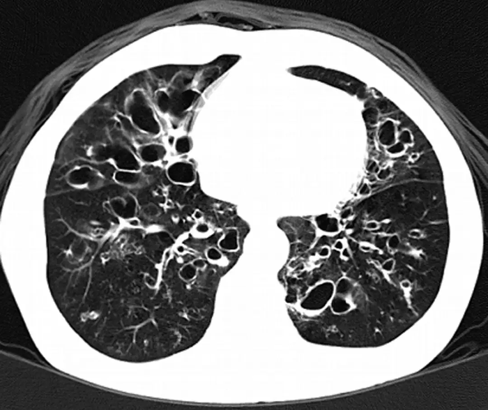 ct表现:支气管壁增厚和气道扩张4,其他表现:长期患病或反复继发感染可