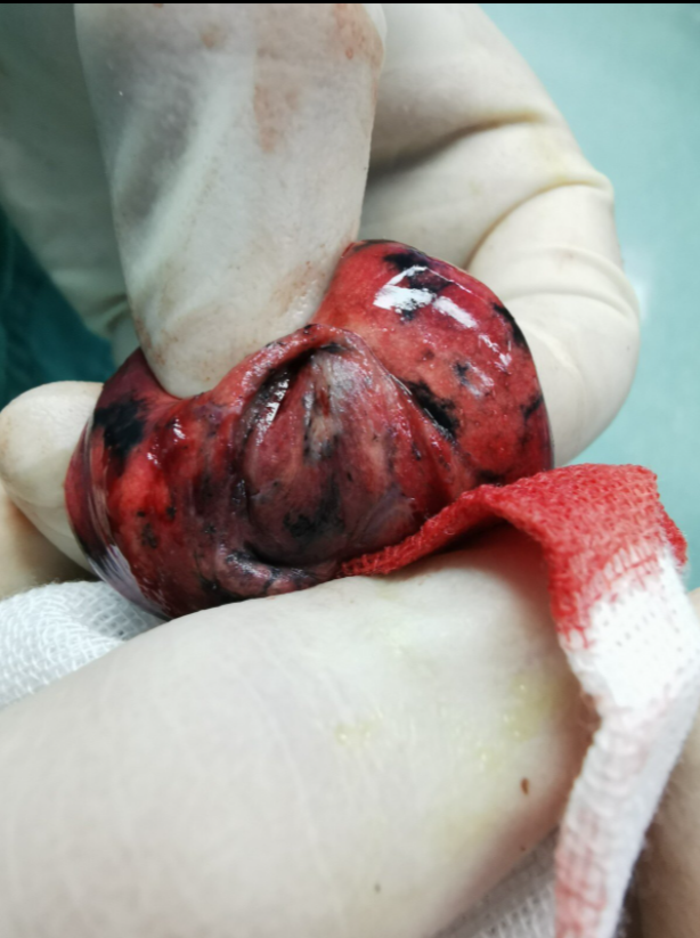 恶行肺部小结节的不同形态