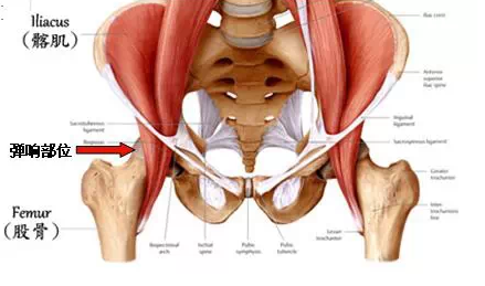 弹响髋可由髂腰肌腱或其下滑囊的结构紊乱引起.