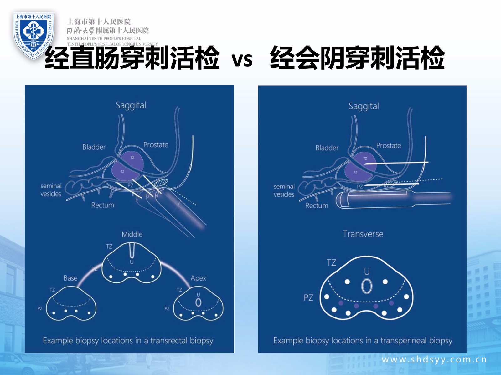 新技术介绍:前列腺癌早期诊断的融合靶向精准穿刺活检