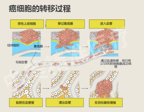 你知道癌细胞是怎么转移的吗
