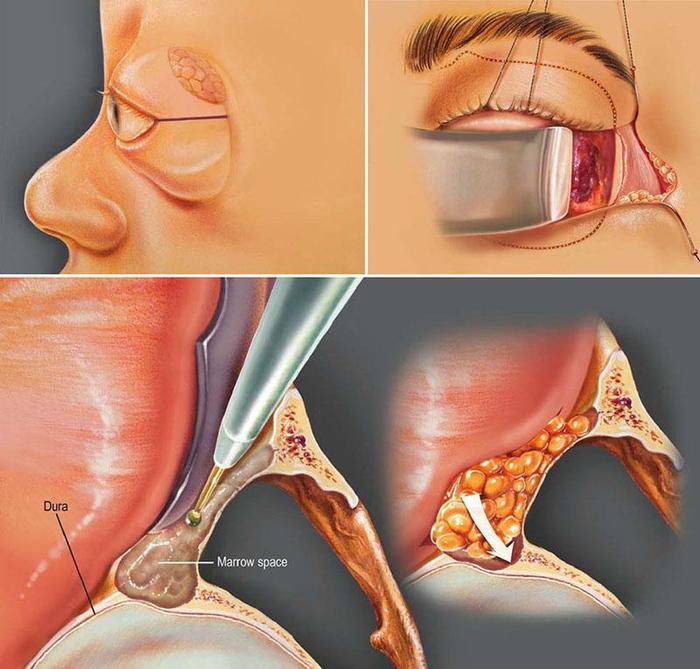 眼眶外壁减压手术,减压范围和切口漫谈! - 微医(挂号网)