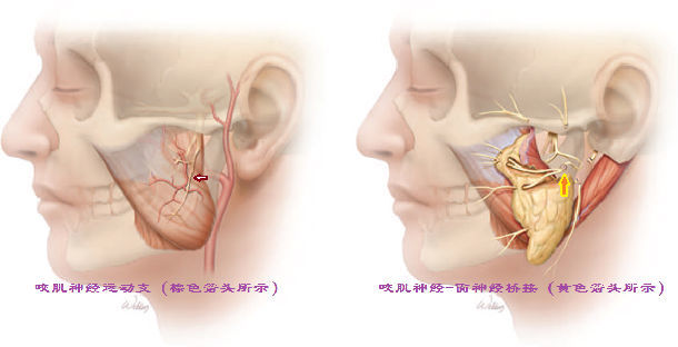 面瘫手术治疗专题一:咬肌神经吻合术(附病例照片)