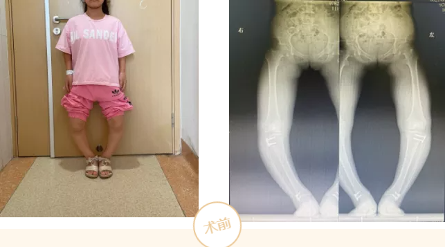 儿童骨骼先天发育不良,o型腿严重,胫骨高位截骨来拯救!