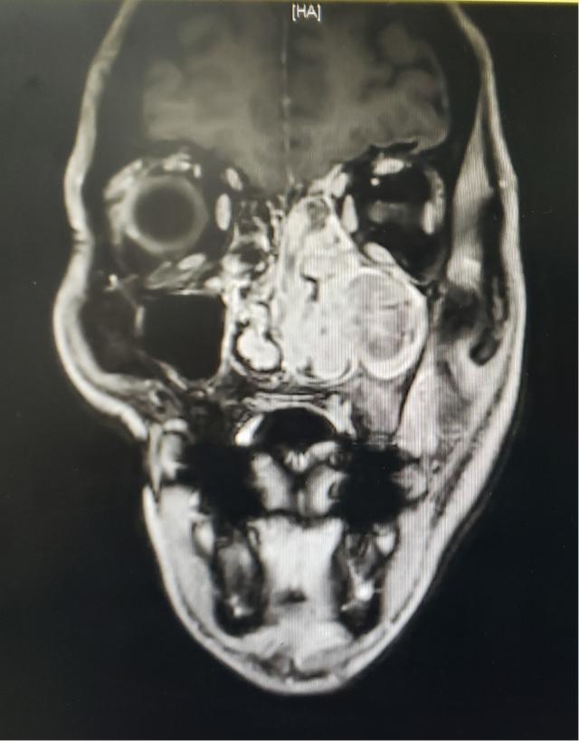 一例鼻咽癌放疗诱导的左上颌颅底骨肉瘤较为棘手的病例