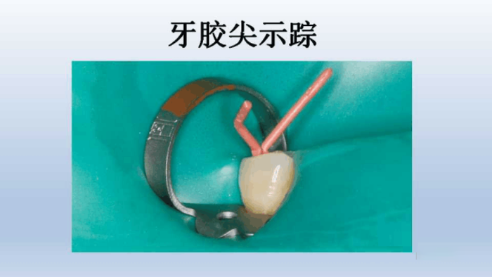 使用牙胶有没有影响_用牙胶好吗_牙胶什么时候用