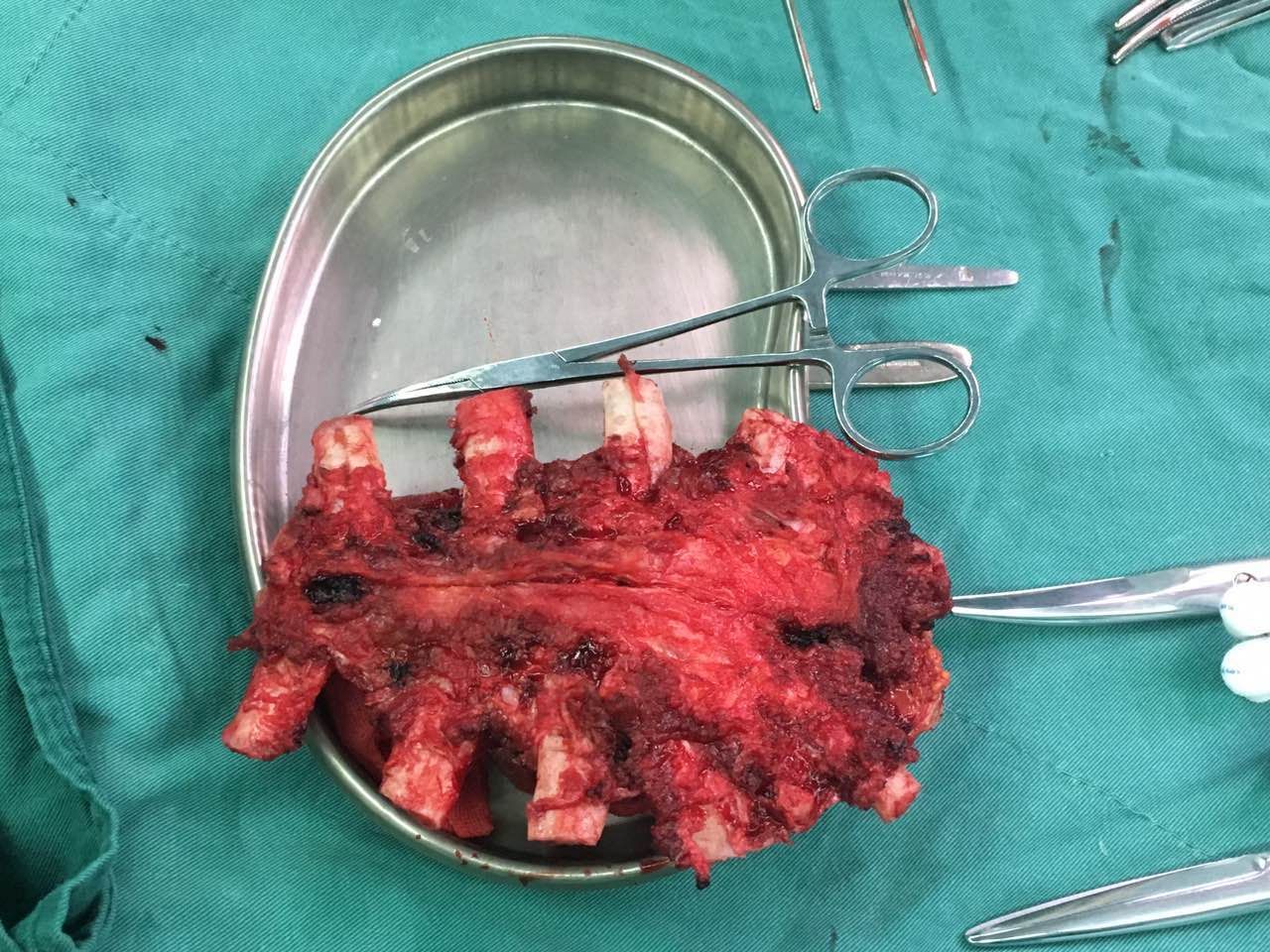 邓波团队成功利用3d打印胸骨治疗胸骨肿瘤