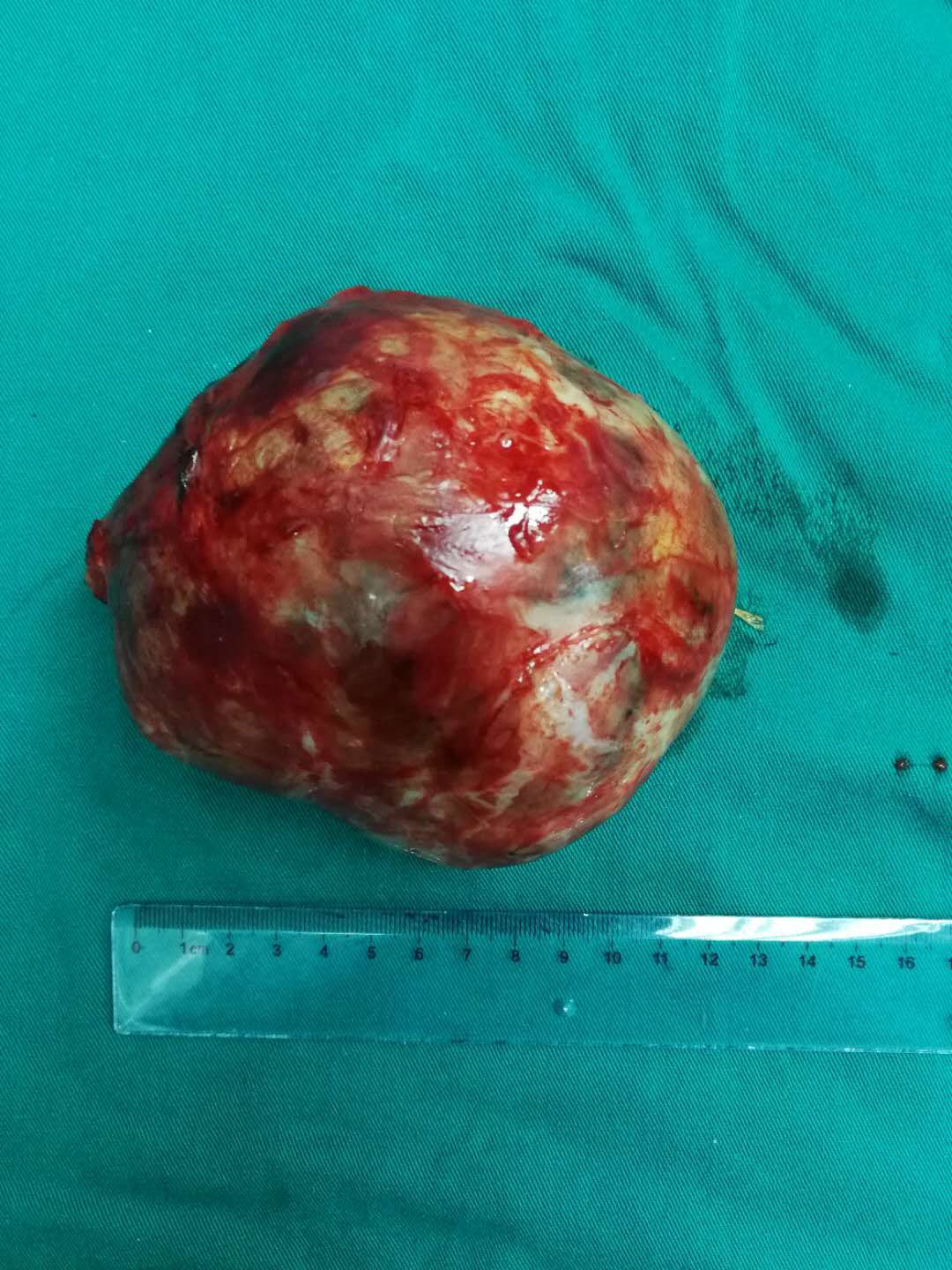 老伯血压飙至325竟是肾上腺长肿瘤