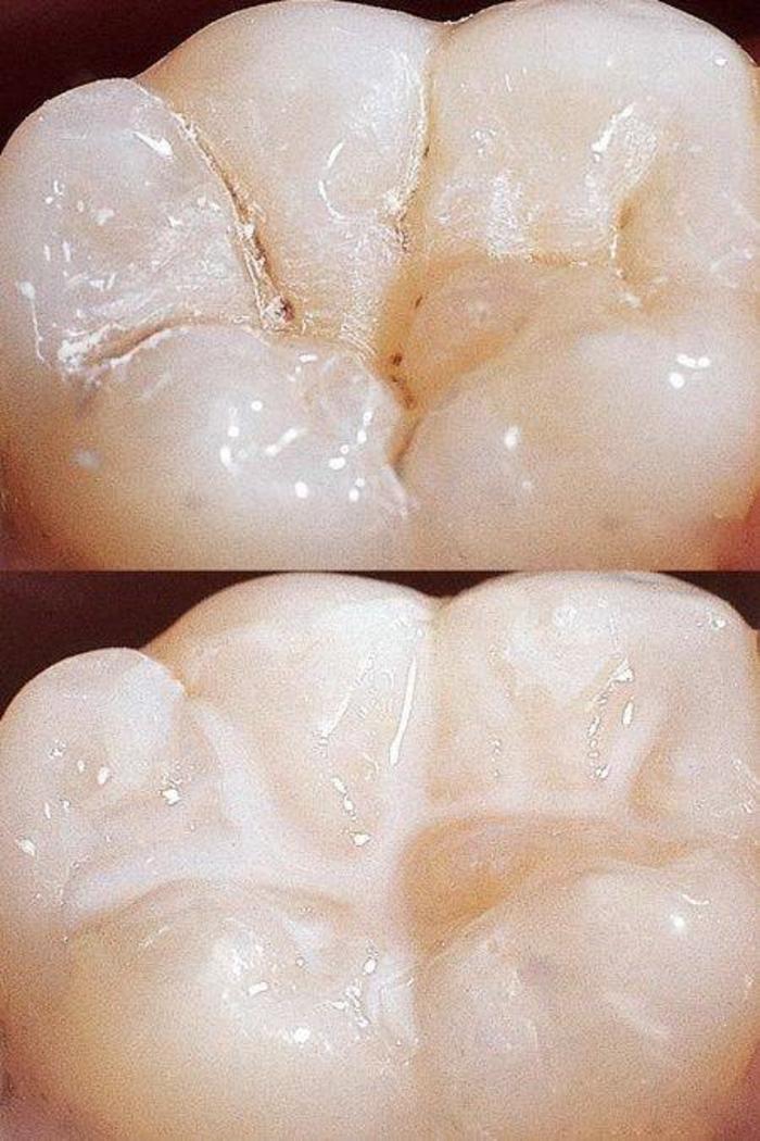 聊聊窝沟封闭那些事