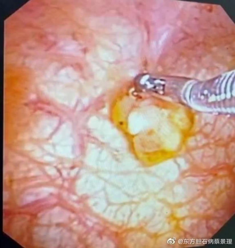 胆囊息肉 难道只能 一切了之 健康号 微医