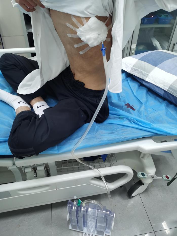 典型案例:气胸诊疗全记录,高考第一天自发性气胸发作