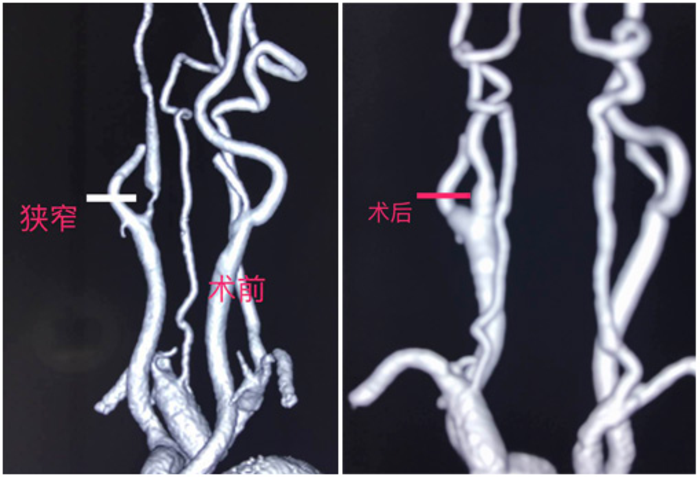 颈动脉狭窄手术治疗后能恢复健康吗
